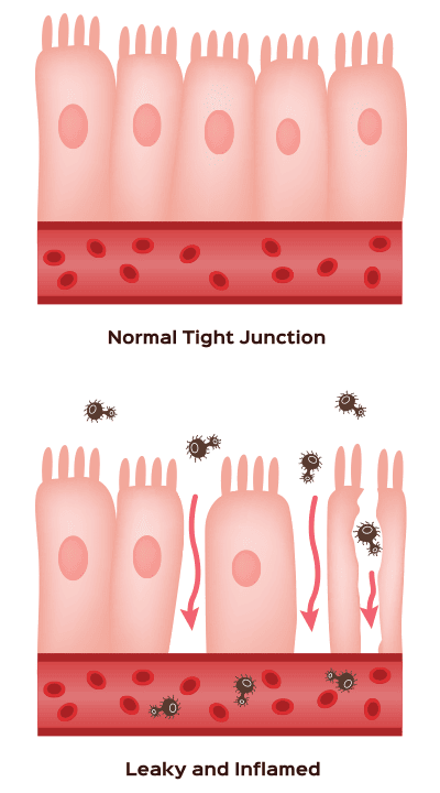 diagram showing the difference between a normal gut and gut suffering from leaky gut syndrome