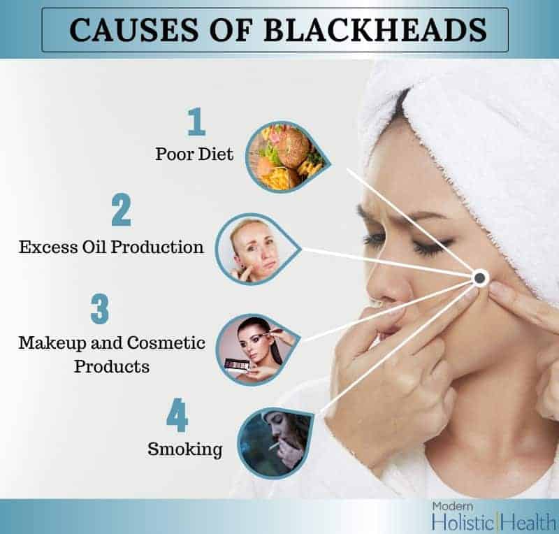 Blackhead Removal Solutions 1